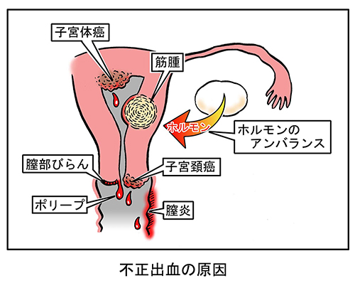 不正出血 症状から考える婦人科疾患