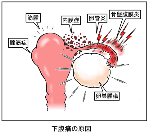 が 痛い 下腹