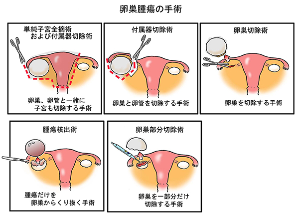 卵巣 摘出 後 の 体調