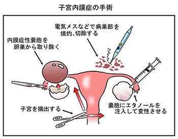 痛い 子宮